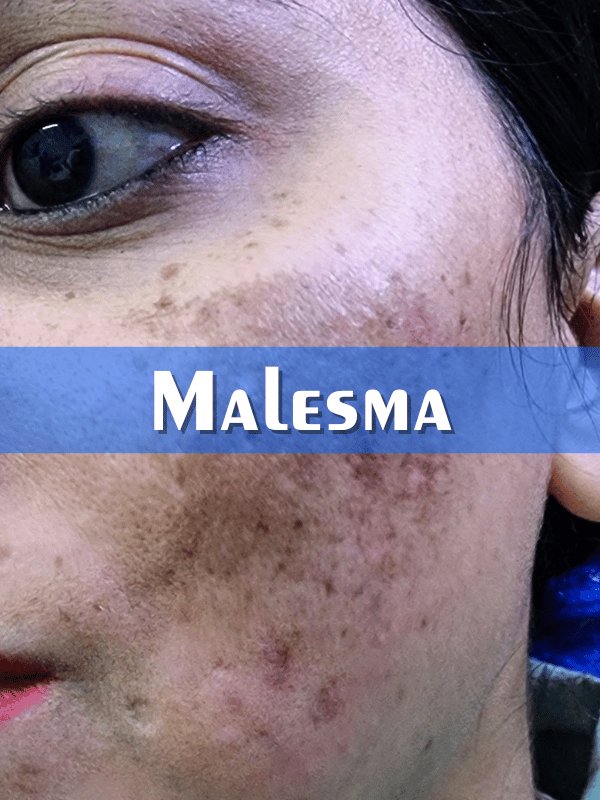 Melasma Treatment